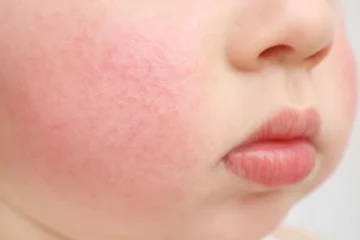 Fifth Disease in Babies