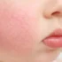 Fifth Disease in Babies